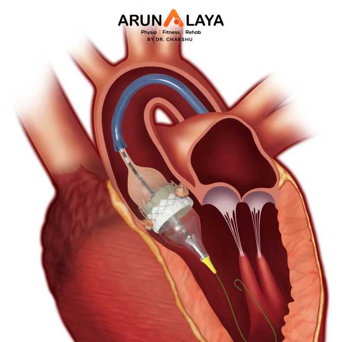 valvular surgery treatment and cure