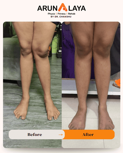 bursae knee