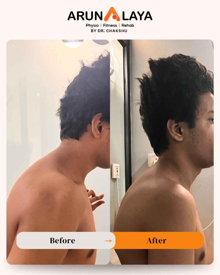 cervical spondylolisthesis treatment