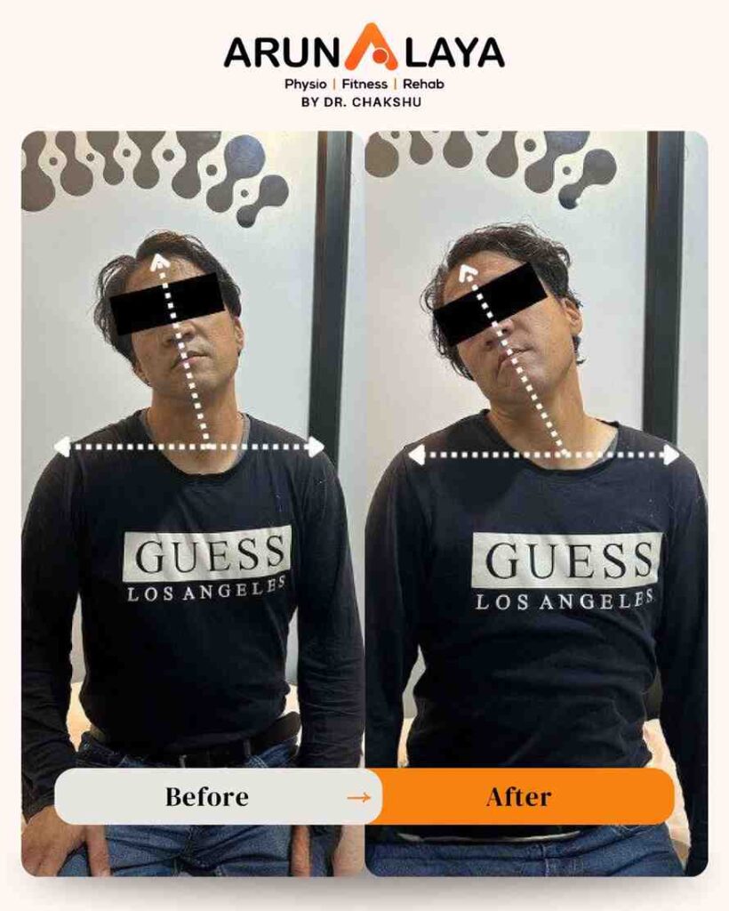 symptoms for cervical spondylitis