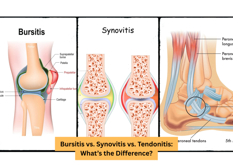 Bursitis vs. Synovitis vs. Tendonitis: What’s the Difference?