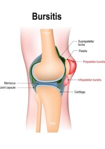 Bursitis