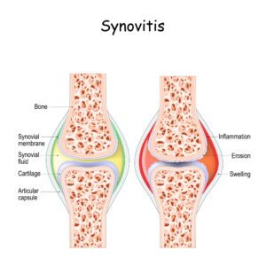 Synovitis