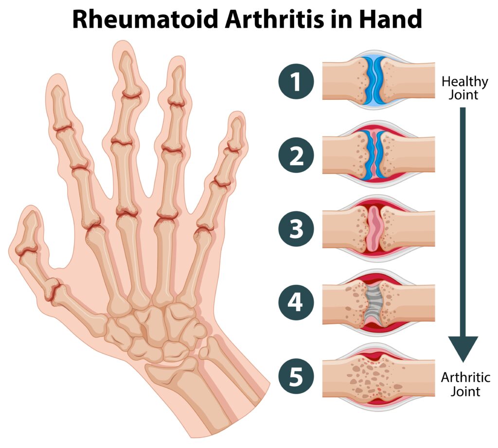 RHEUMATOID ARTHRITIS