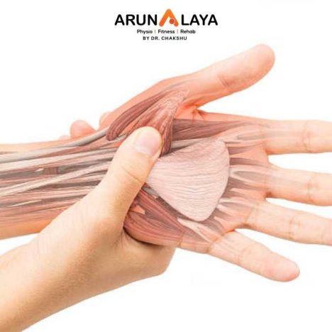 carpal tunnel syndrome treatment without surgery